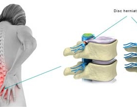 Viêm quanh khớp vai cần xử trí như thế nào?